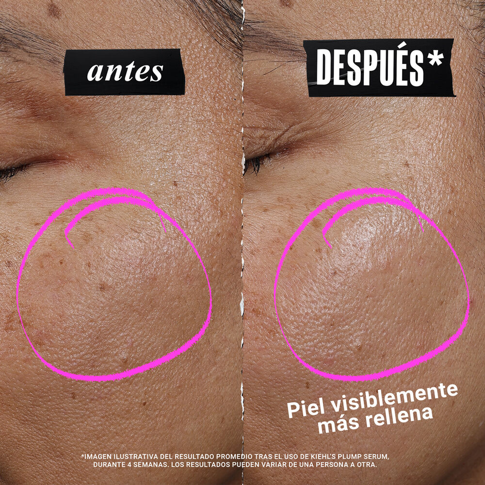 Antes y despues de mejilla. El "Despues" muestra una piel con mas volumen, suave e hidratada frente al "Antes". Enfocado en los resultados.