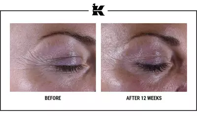 Antes y despues Super Multi-Corrective Eye Zone Treatment