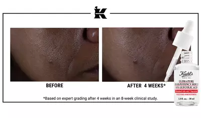 ANTES Y DESPUES Glycolic Acid Serum