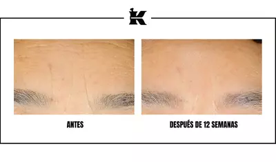 ANTES Y DESPUES Retinol Serum